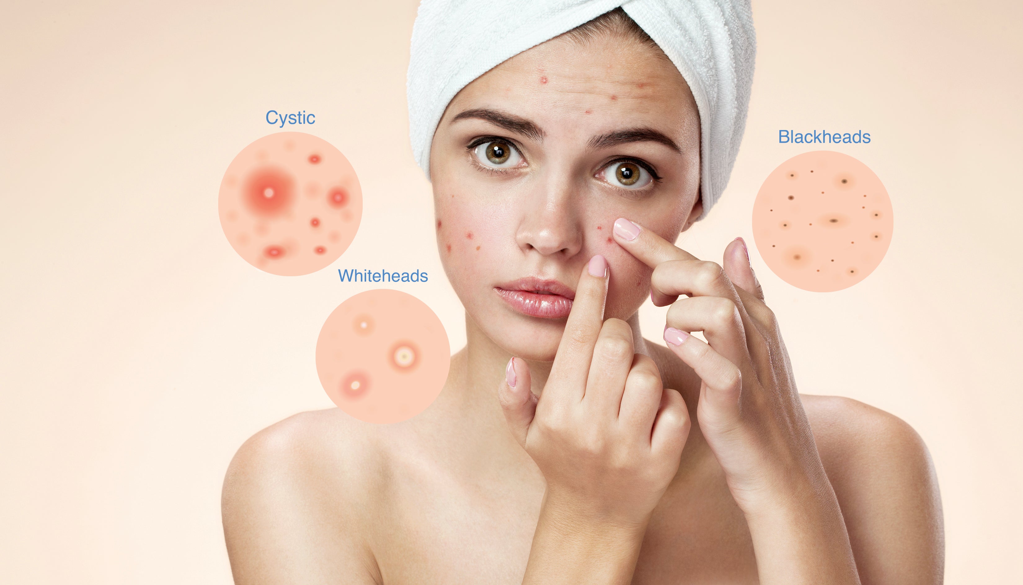 Whitehead vs Cystic vs Blackhead Acne How to effectively use Acne pat